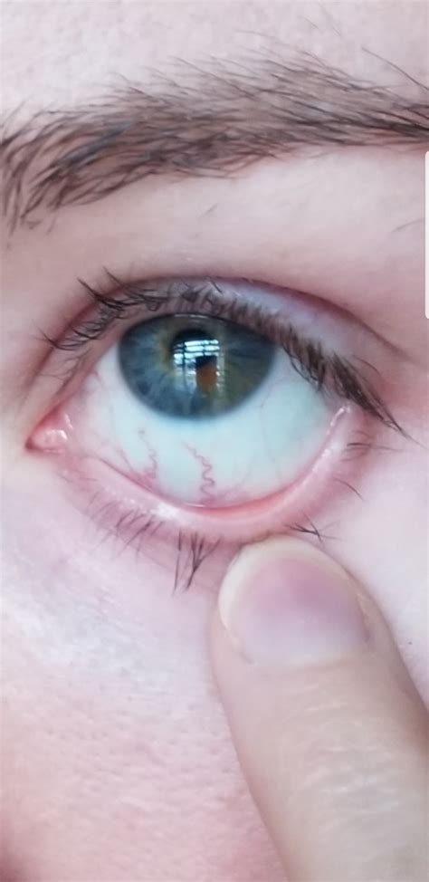 Are the whites of my eyes normal? : r/optometry