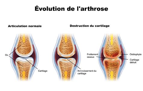 L'arthrose : Cause , Symptômes , Traitement , Prévention