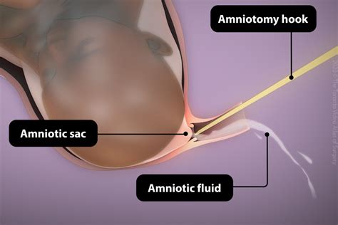 Patient Education: Induction of Labour procedure - The Toronto Video Atlas of Surgery