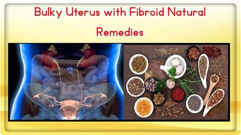 Bulky Uterus with Fibroid Natural Remedies - YouTube