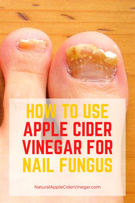 How to Use Apple Cider Vinegar for Nail Fungus - All Natural Home ...