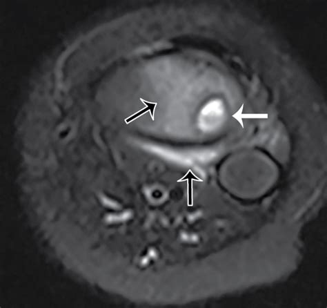 Who’s Brodie? Brodie abscess | Radiology Key