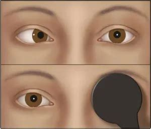 Cover test - American Academy of Ophthalmology