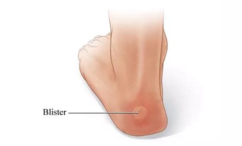 How do I treat blisters on my feet? | Florida Foot & Ankle Treatment Center