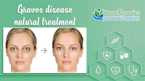 graves disease eyes treatment | graves disease treatment | graves ...