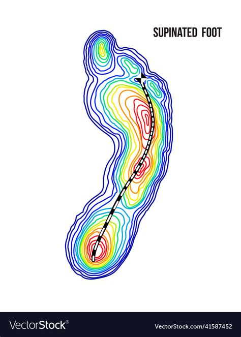 Supinated foot arch deformation bottom view Vector Image