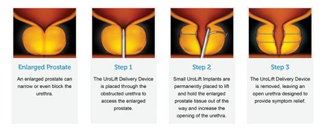 UroLift Specialist, UroLift Treatment | Desert Sky Urology | Arizona