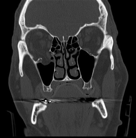 Blowout fracture with inferior rectus entrapment | Image | Radiopaedia.org