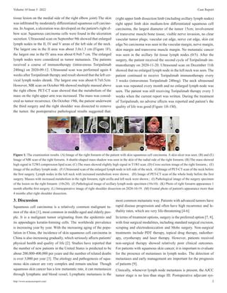 A Case of CR Efficacy of Toripalimab for Stage IV Cutaneous Squamous Cell Carcinoma | PDF