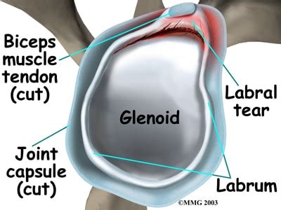 Labrum Tear of The Shoulder