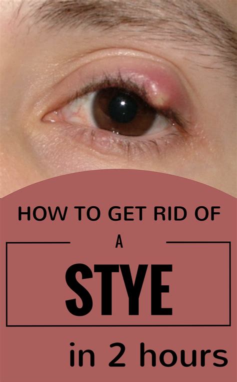 How To Get Rid Of A Stye In 2 Hours - 101BeautyTips.org | Eye stye ...