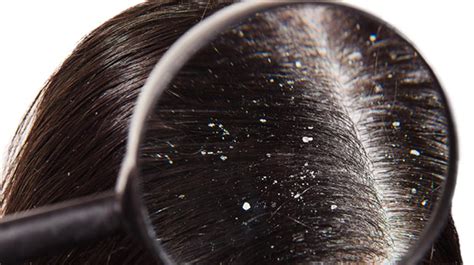 How Do I Know if I Have a Dry Scalp, Sensitive Skin, Dandruff or Seborrheic Dermatitis ...