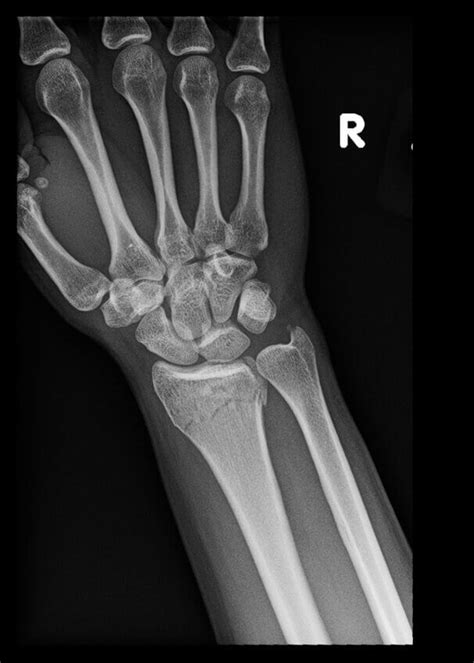 OrthoDx: Extensor Pollicis Longus Tendon Rupture - Clinical Advisor