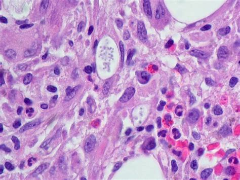 Fungal infection, Bone Marrow (1) | Patient has rheumatoid a… | Flickr
