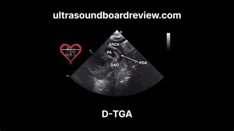 Transposition of the Great Arteries (d-TGA) Echocardiography - YouTube