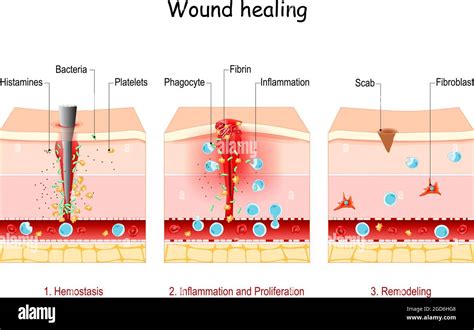 wound healing. Stages of the post-trauma repairing process. Hemostasis, Inflammatory ...