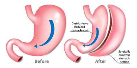 Gastric Sleeve Complications - Tijuana, Mexico - Dr. Francisco Gonzalez