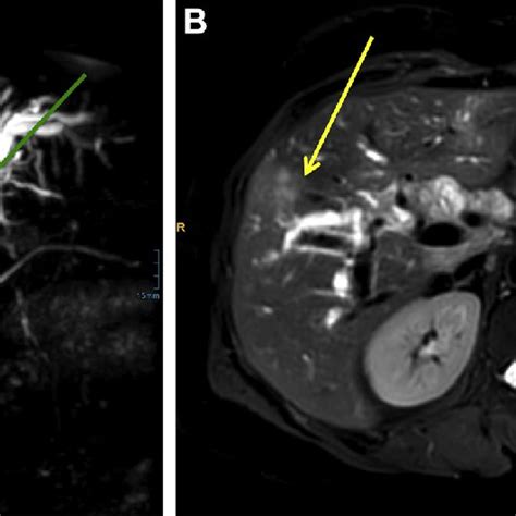 E Ultrasound Image Of Intrahepatic Biliary Dilatation With The | Images ...