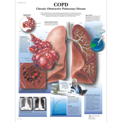 Lehrtafel - COPD Chronic Obstructive Pulmonary Disease - 1001522 - 3B Scientific - VR1329L ...