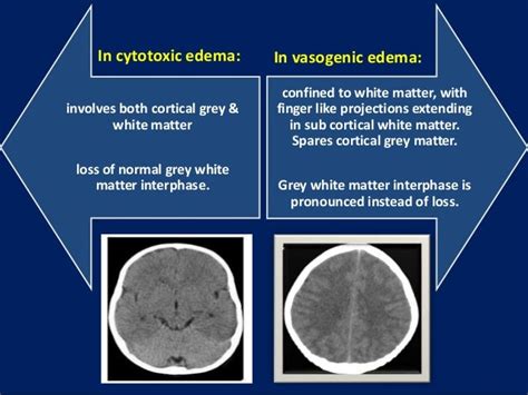 Brain edema