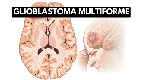 Inside Glioblastoma Multiforme: A Journey into the Deadliest Brain ...