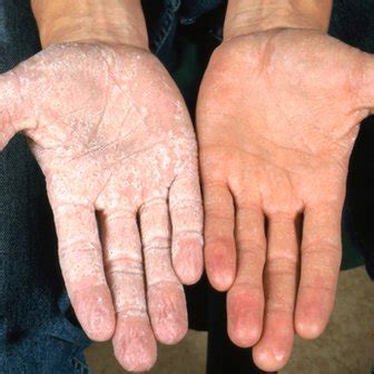 News • Keratoderma, Palmoplantar