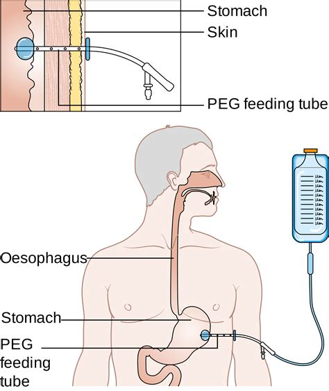 Gastrostomy Feeding