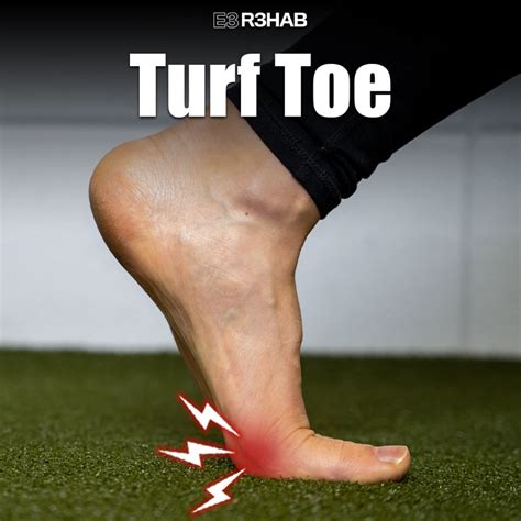 Turf Toe - Motus Physical Therapy