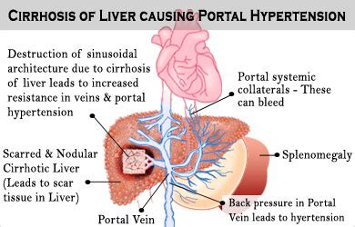 Portal Hypertension - Causes, Symptoms, Diagnosis, Treatment, Recovery