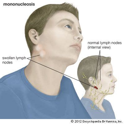 Infectious Mononucleosis Swollen Lymph Nodes