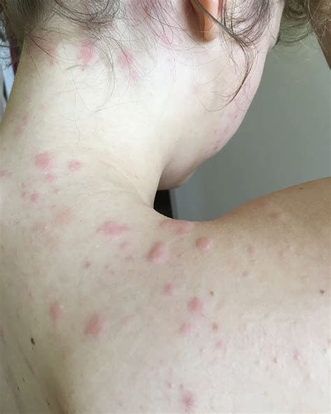 Bed Bugs Rash Treatment