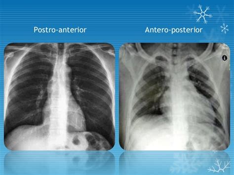 basics of chest X- ray interpretation