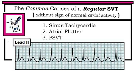 Atrial flutter causes - agrilokasin