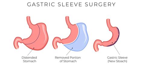 Gastric Sleeve Bariatric in Turkey - ClinicResort