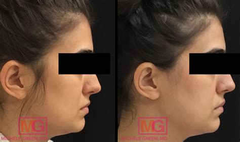 Kybella Swelling & Potential Side Effects, How To Lessen Swelling