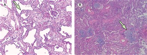 Interstitial Pneumonia Histology