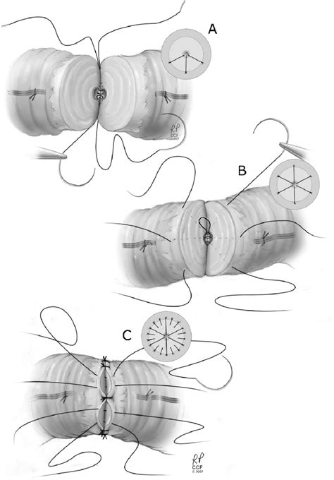 Modified two-layer vasovasostomy. | Download Scientific Diagram