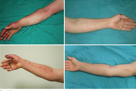 Figure 1 from Traumatic acute lymphangitis in the upper extremity ...