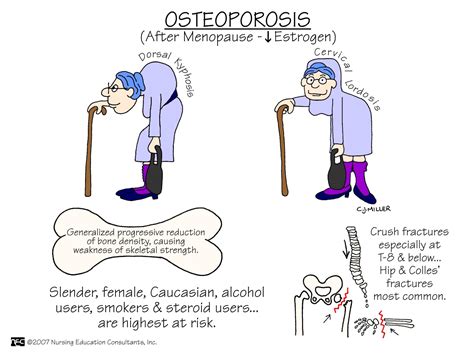 The Natural Treatment For Osteoporosis - My Life With No Drugs