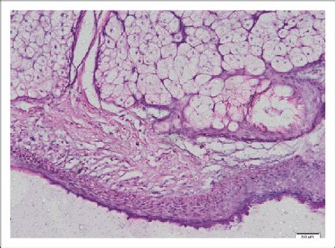 Left ovarian cyst. Histopathology aspect in HE coloration sugestive for... | Download Scientific ...