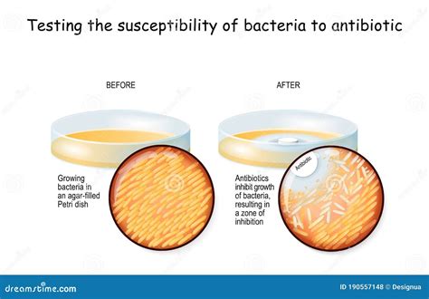 Bacteria and Antibiotic in a Petri Dish Stock Vector - Illustration of antimicrobial, difference ...