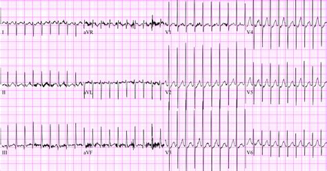 The EKG shows a narrow, regular complex tachycardia consistent with SVT