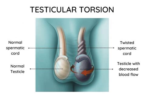 Testicular Torsion Following Inguinal Hernia Surgery – A Detailed Study