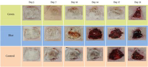 Effect of Laser Photostimulation on the Healing of Third-Degree Burn ...