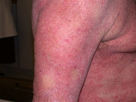 Mycosis Fungoides and Sézary Syndrome - Dermatology Advisor