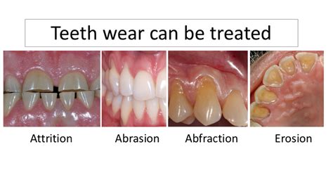 Teeth Wear | Faces and Smiles