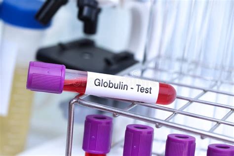 Globulin Test To Look for Abnormalities from Blood Stock Photo - Image of equipment, anemia ...