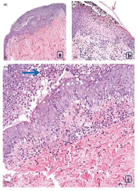 Histopathology of acute generalized pustular psoriasis A.Subcorneal ...