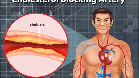 Comprehensive Guide to Carotid Artery Blockage Treatment