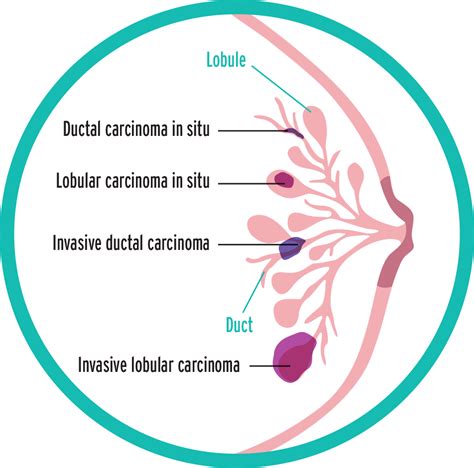 Common types of Breast Cancer presentations - Emabal Hospitals Limited